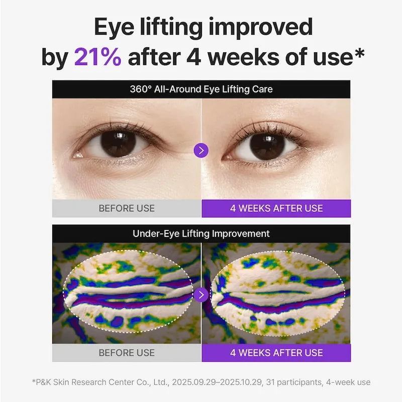 Voor- en na-afbeelding van de oogzone voor en na vier weken gebruik van de 360º Shot PDRN Lifting Eye Cream.