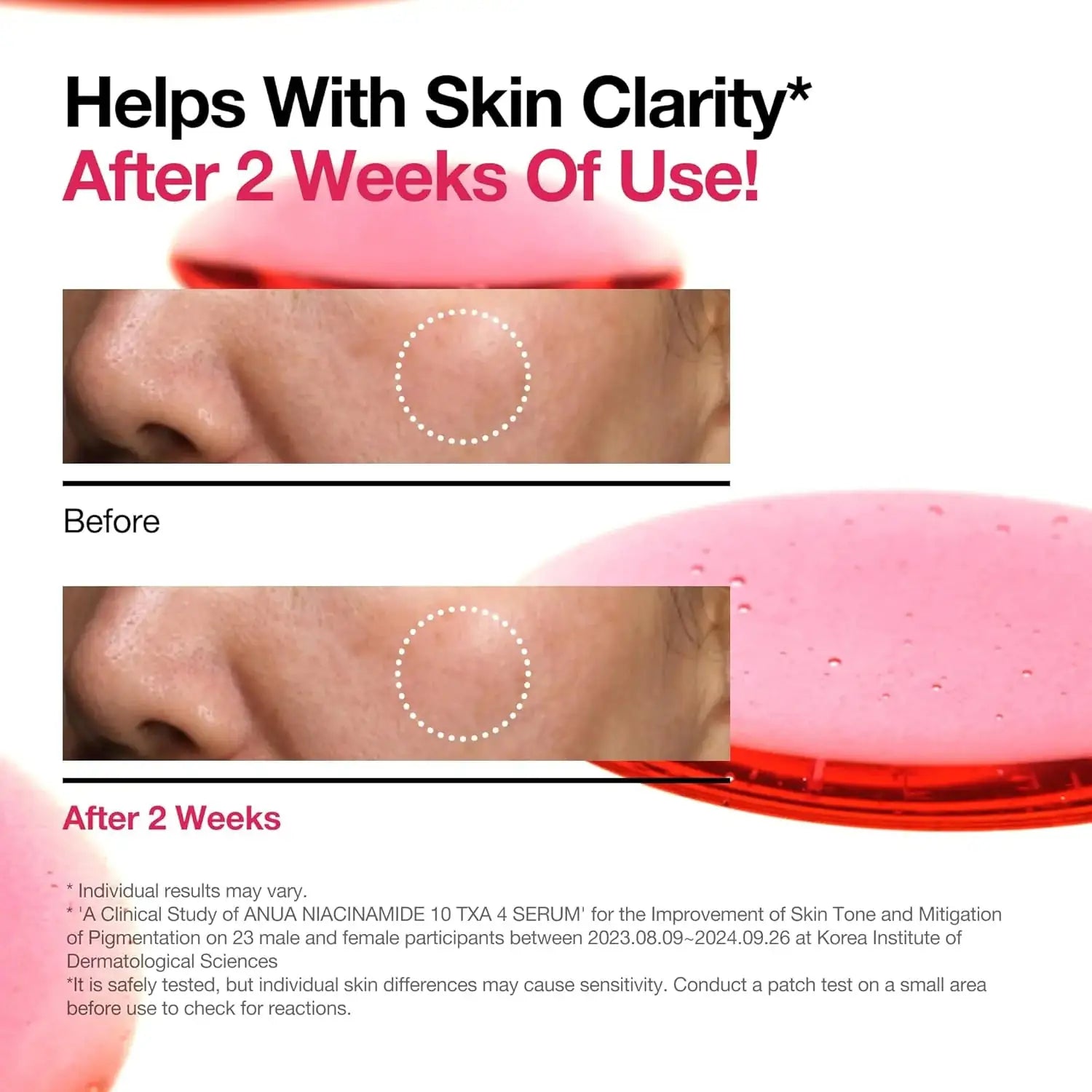 Anua Niacinamide 10%+TXA 4% Dark Spot Correcting Serum Anua 10+ serumflesrand bovenaan; huidvoor-na collage met gemarkeerde plek