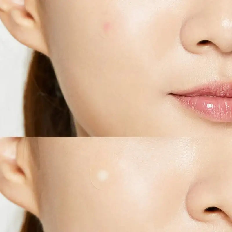 Hydrocolloïde acnepleister op wang, huid close-up met pleisterplek